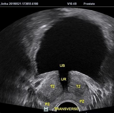 Axial B Mode Ultrasound Of The Prostate Showing Prostatic Zones Pz