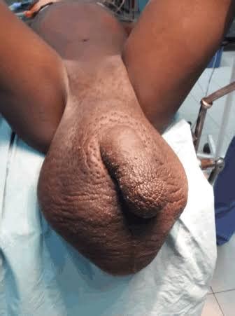 Swollen Glands Genital Area Hot Sex Picture