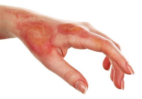 Burn Injuries What You Should Know
