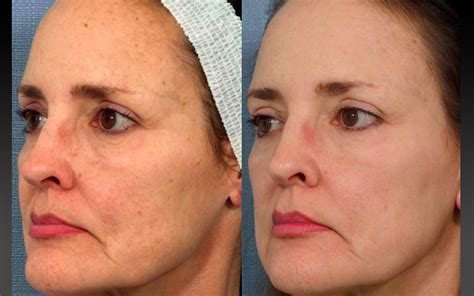 Ipl Photofacial Limelight Vancouver Skin Solution Clinic
