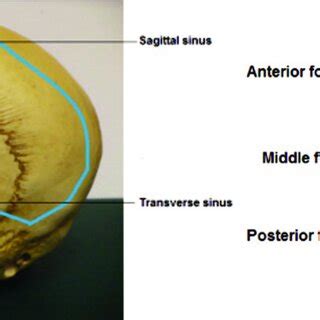 Superior Sagittal Sinus And Transverse Sinus Of The Vault Left And