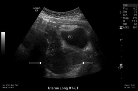 Sonographic Detection Of Cervical Carcinoma With Metastases Clare E