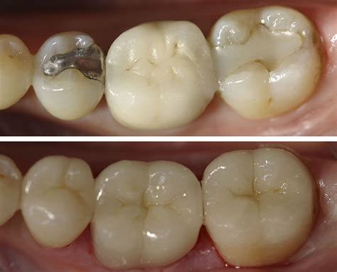 You Must Know Tooth Filling Before And After 5 Tooth Bantuanbpjs