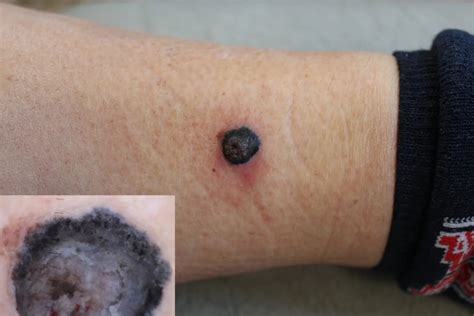 Melanoma Pictures Skin Changes And What To Look For