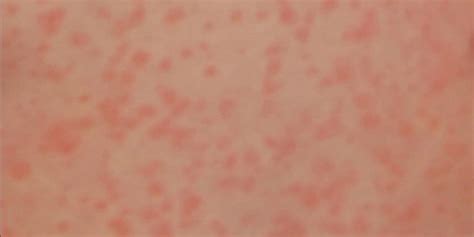 These Skin Conditions Can Be Symptoms Of Coronavirus