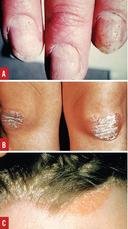 Psoriasis A Review Of Diagnosis And Treatment In The Primary Care
