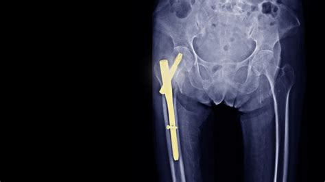 Intertrochanteric Fracture Repair