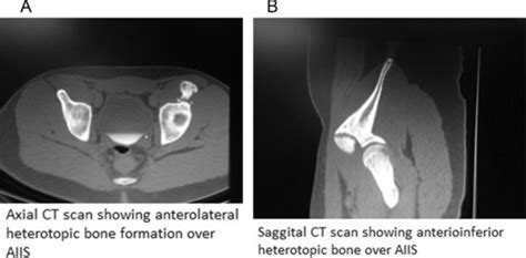 Axial Ct Scan Showing Anterolateral Heterotopic Bone Formation Over