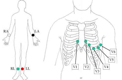 6 Positions Of Electrodes Used In A Standard 12 Lead Ecg