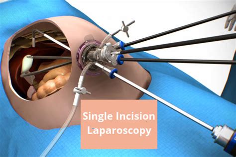 Laparoscopic Cholecystectomy Ports