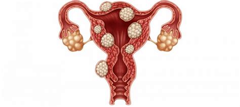 Fibromas uterinos Dr Rolando R Pinilla Jaén Ginecología y Obstetricia