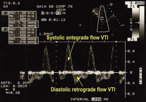 Clinical Assessment Of Diastolic Retrograde Flow In The Descending