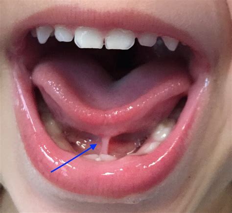 What Is A Tongue Tie And It S Causes Health Wellness