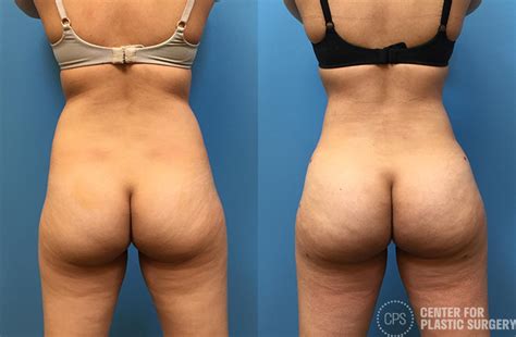 Brazilian Butt Lift Before After Photos Patient Chevy Chase Annandale Washington D C