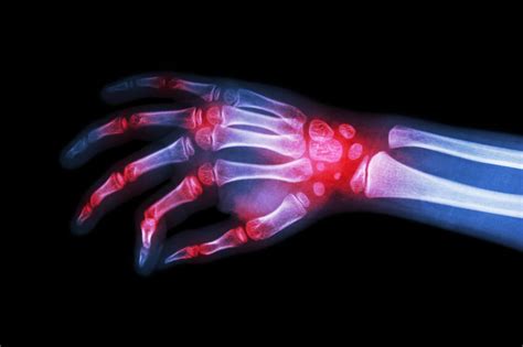 Carpal Tunnel Syndrom — 360 Physical Therapy And Wellness In Fulton Md