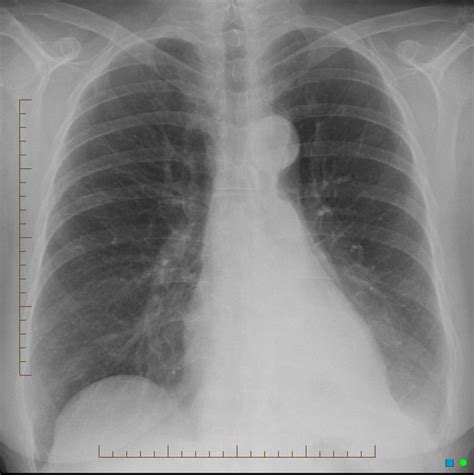Lungs Left Lower Lobe Collapse The Retrocardiac Part Of The Left