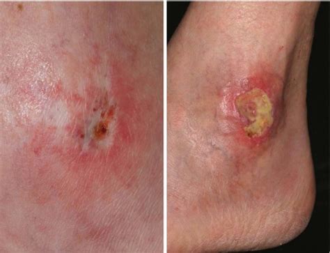 This pathway assists staff in determining the appropriate care for the individual resident. Skin Necrosis and Ulcers Induced by Medications | Plastic ...