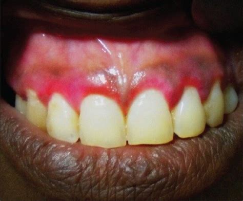 Erythematous Labial Gingiva In Relation To Maxillary Incisor Teeth