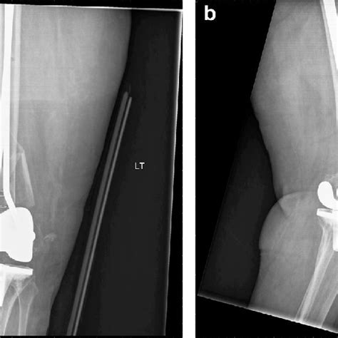 Ap A And Lateral B Radiographs Of The Right Knee Postoperatively