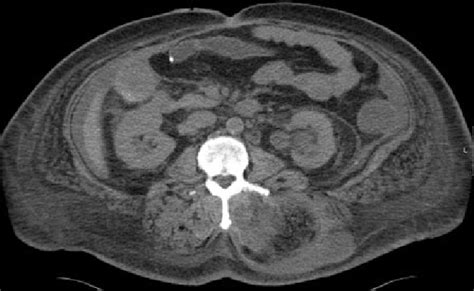 Diffuse Soft Tissue Edema