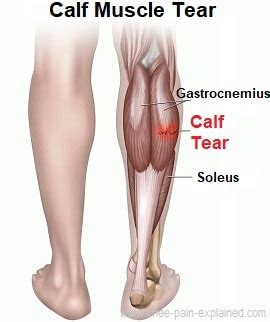The quadriceps is a large group of muscles in the front of the thigh that straighten out the knee, the opposite action from the hamstrings. Calf Muscle Tear Treatment Guide - Knee Pain Explained