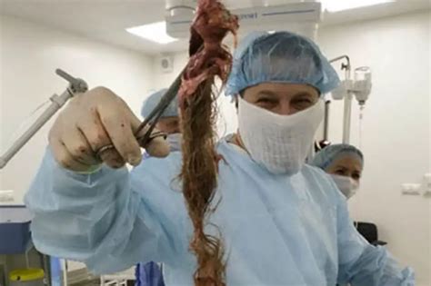 Docs Remove Huge Hairball From Womans Abdomen Viraltab