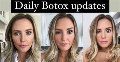 Blogger Opens Up About Her Experience With Ptosis A Rare Botox Side