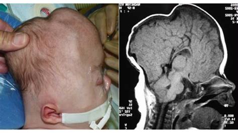 Neonatal Craniofacial Program Childrens Hospital Of Philadelphia