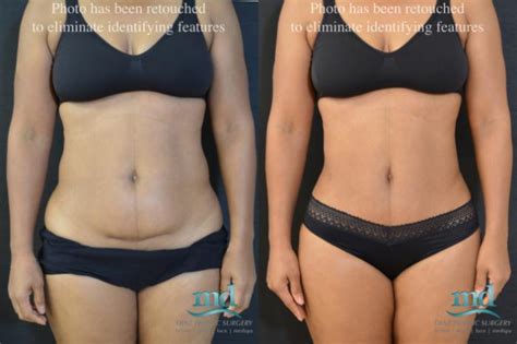 Mini Tummy Tuck Before And After Photos Case 19 Melbourne Fl
