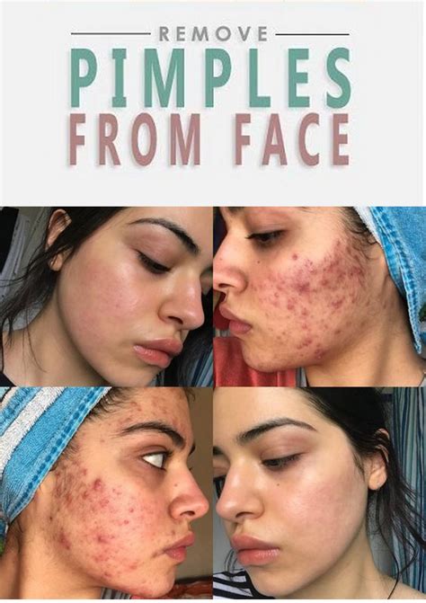 How To Get Rid Of Pimples Acne Overnight Fast In 2020 How To Remove