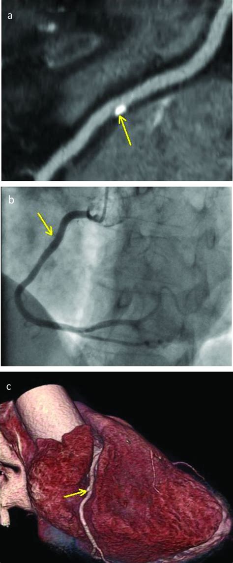 Computed Tomographic Coronary Angiography Is It Ready As A Screening