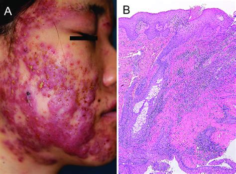 Case 1 A Subcutaneous Abscesses And Pustules On The Face With