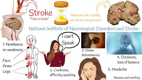 Stroke Ischemic Stroke Symptoms And Treatment Hemorrhagic Stroke Symptoms And Treatment Youtube