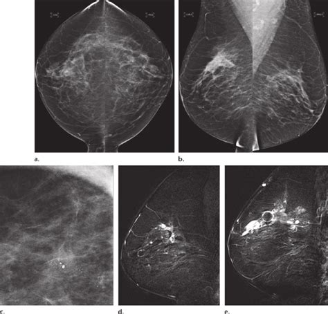 Dcis And Invasive Lobular Cancer In A 45 Year Old Woman Ac