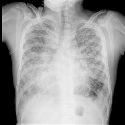 Down syndrome subpleural cysts | Radiology Case | Radiopaedia.org | Cysts, Down syndrome, Syndrome