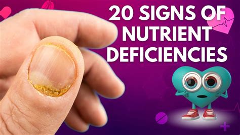 20 Signs Your Body Is Deficient In Nutrients Youtube