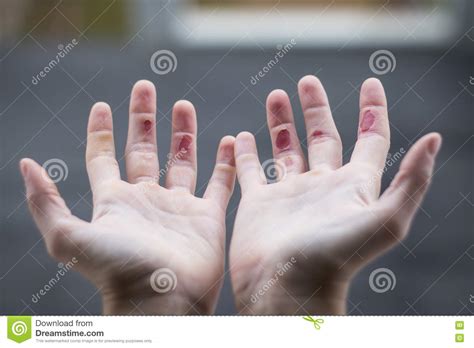 Climber S Fingers Stock Photo Image Of Fingers Abraded 77932354