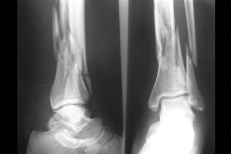 Fracture Of The Posterior Process Of Talus With Pilon Fracture A Case