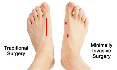Current Concepts In Minimally Invasive Bunion Surgery