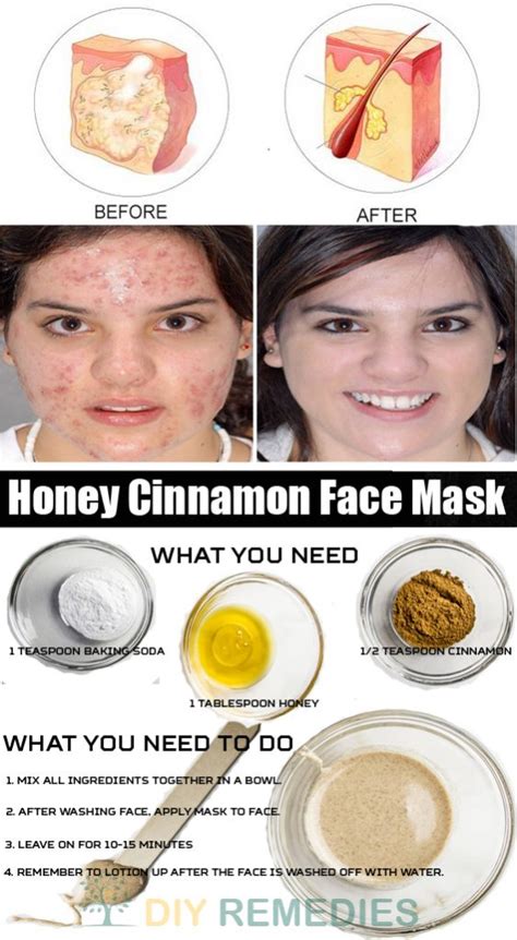 The complete acne guide 2020: The Most Effective And 100% Natural Anti Acne Face Masks ...