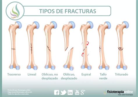 Fracturas óseas Qué Es Causas Síntomas Tratamiento Y Consejos