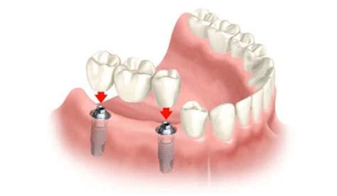 How To Replace Back Teeth What You Need To Know