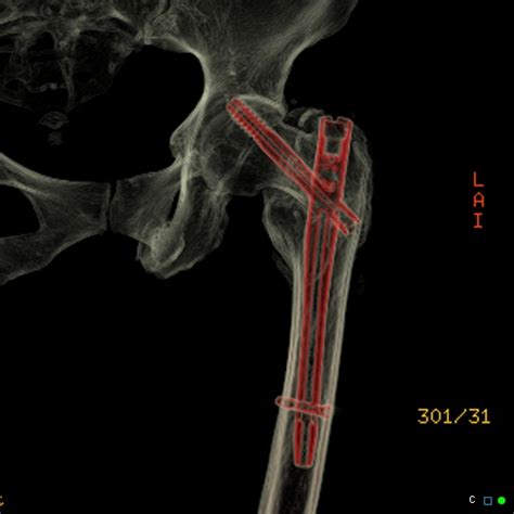 Cut Out Lag Screw Neck Of Femur Fracture Gamma Nail Image