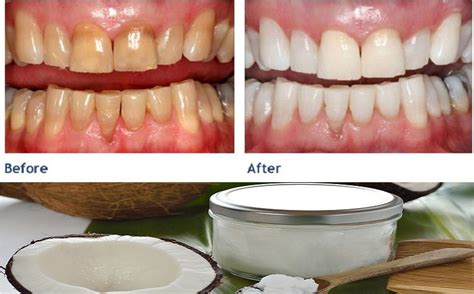 Coconut Oil Your Answer To Better Oral Health And Whiter Teeth