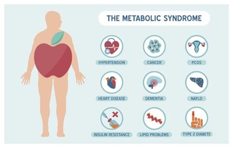 Is Metabolic Syndrome Causing Your Overactive Bladder Ms Urology