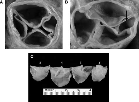 Quadricuspid Aortic Valve Circulation