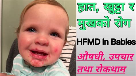 Hand Foot Mouth Disease Treatment In Nepali Treatment Of Hfmd