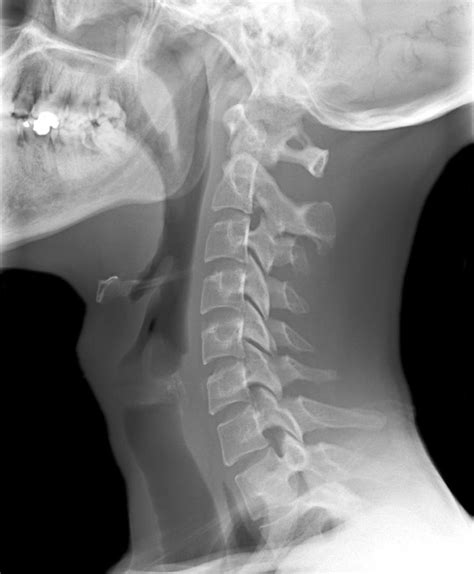 Normal Neck X Ray Photograph By Du Cane Medical Imaging Ltd