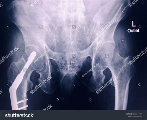 Xray Pelvis Outlet Spinal Column Male Stock Photo 1606511134 Shutterstock