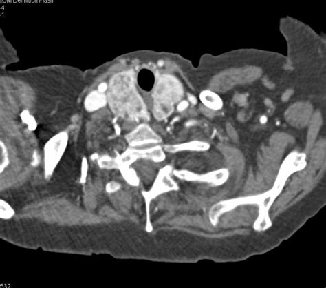 Substernal Extension Of Thyroid Goiter Chest Case Studies Ctisus Ct